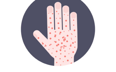Measles Outbreak; Latest Information
